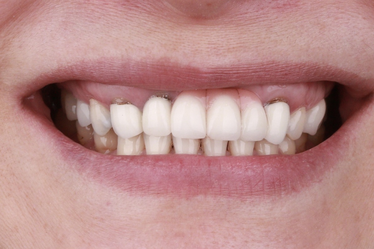 veneer_1_before