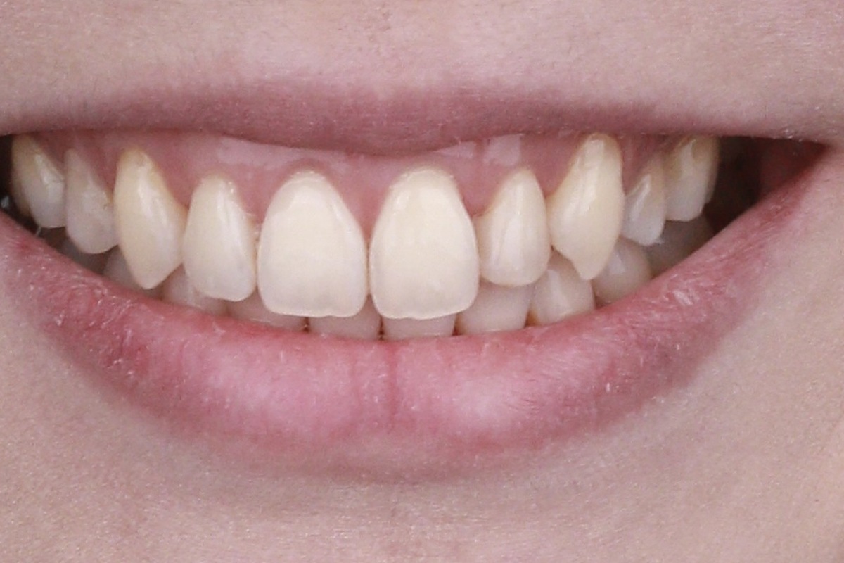veneer_2_before