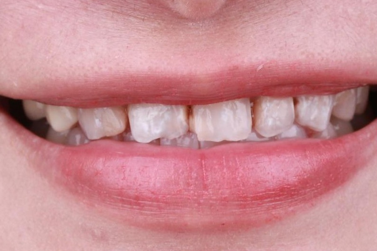 veneer_3_before